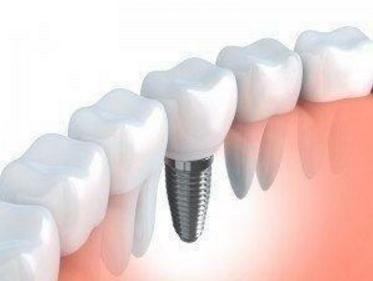 Considering Dental Implants? Here Are Reasons to Do So!